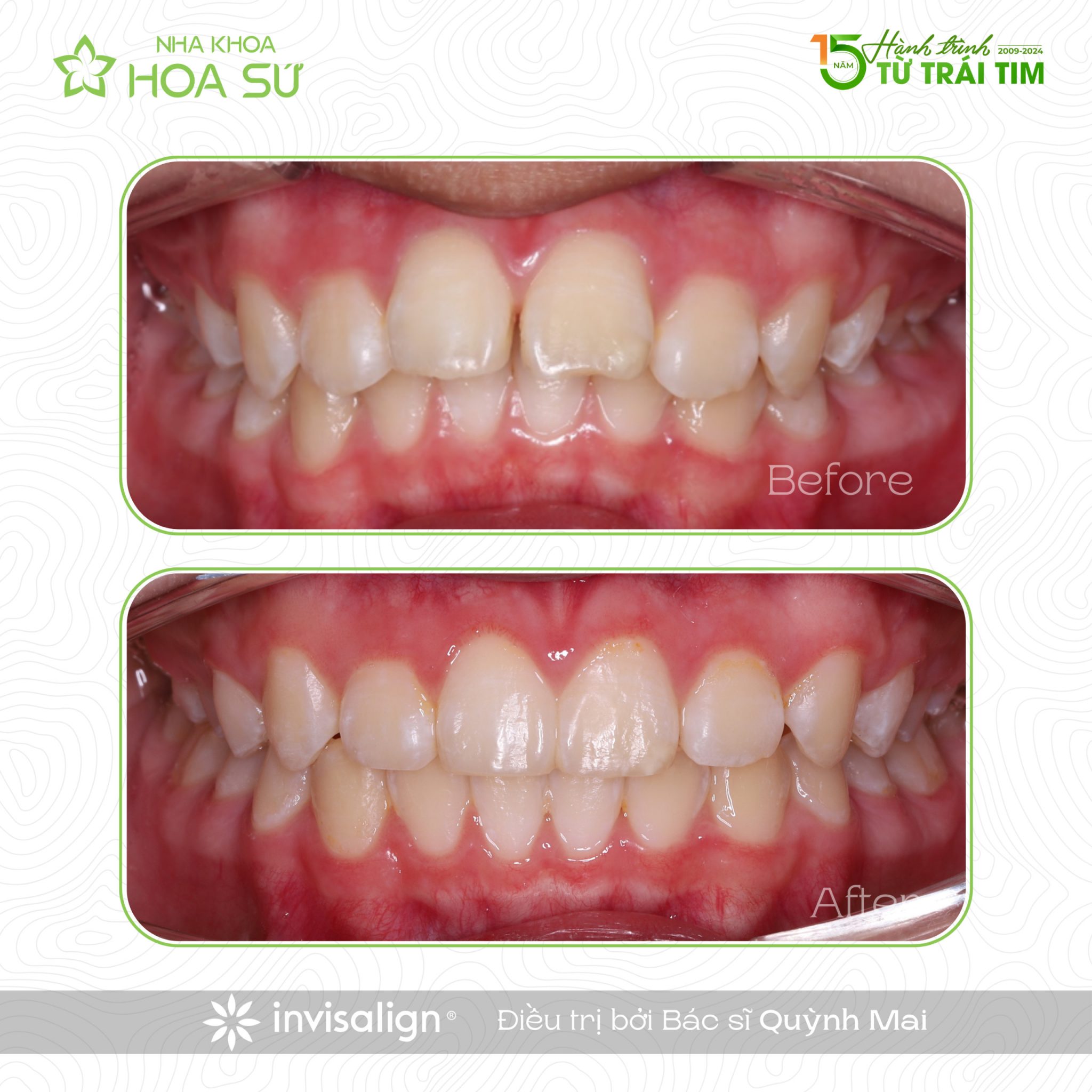 Ma Phase Invisalign INVISALIGN MA - NIỀNG RĂNG TRONG SUỐT CHO TRẺ - Nha khoa Hoa Sứ